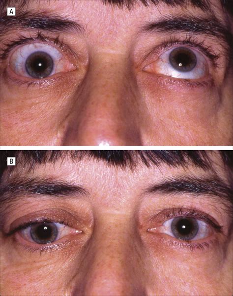 The Inferior Oblique Muscle Adherence Syndrome Ophthalmology Jama