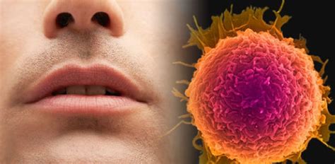 I returned to the ent specialist and he used silver nitrate to stop the. What causes bleeding in mouth cancer? - ProProfs Discuss