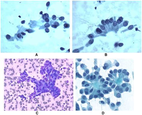 Cytologic Features Of Aggressive Variants Of Follicular‐derived Thyroid