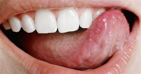 Causes For Ulcers On The Tongue Livestrongcom