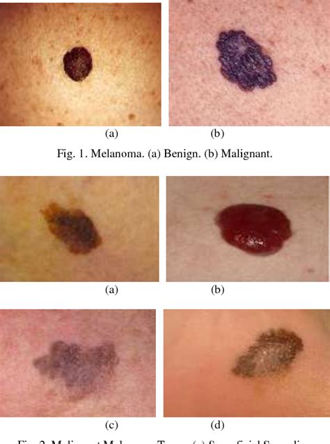 Types Of Melanoma Skin Cancer