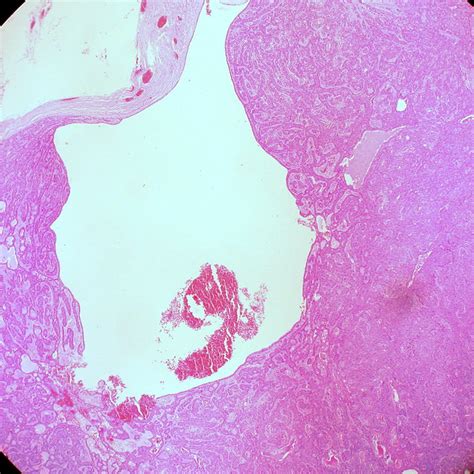 Small, round cells found in the lower part, or base, of the epidermis, the outer layer of the skin. Basal Cell Adenoma of Parotid Gland | Flickr - Photo Sharing!