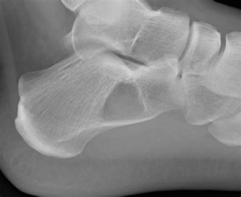 Calcaneal Intraosseous Lipoma Radiology Case