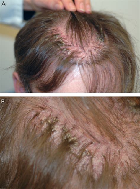 Figure 1 From Folliculitis Decalvans Developing 20 Years After Hair