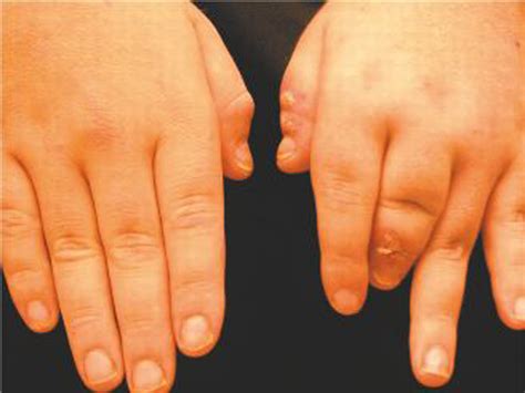 Early Signs Of Arthritis In Fingers Finger Arthritis Signs Symptoms
