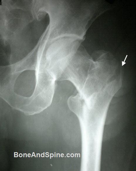 Intertrochanteric Fractures Causes Presentation And Treatment Bone