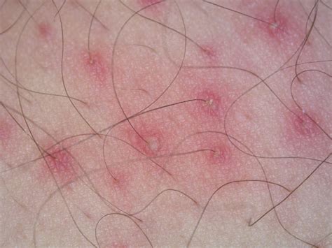 Skin Infection Folliculitis