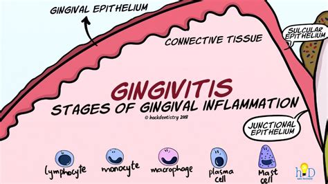 Gingivitis Stages Of Gingival Inflammation Youtube