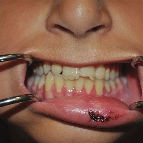The Fragments Of Fractured Maxillary Incisor Extracted From The Lower