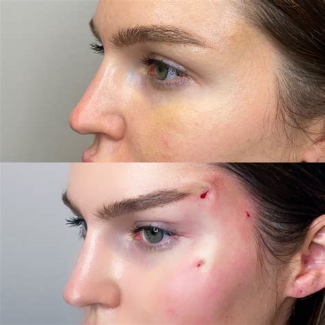 Non Invasive Pdo Brow Thread Lift In Clearwater Florida