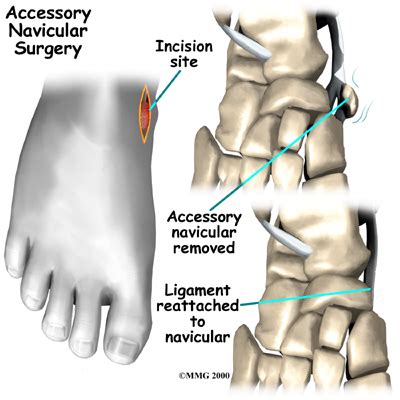 Physical Therapy In Our Clinic For Accessory Navicular Problems