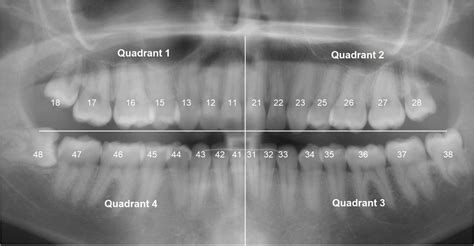 The Panoramic Dental Radiograph For Emergency Physicians Emergency