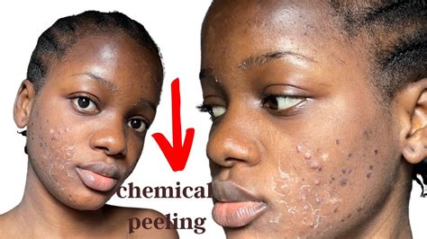 I Got A Chemical Peel For Acne Scars Skin Peeling Experience Youtube