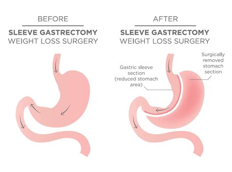 Vertical Sleeve Gastrectomy Gastric Sleeve Surgery Gold Coast