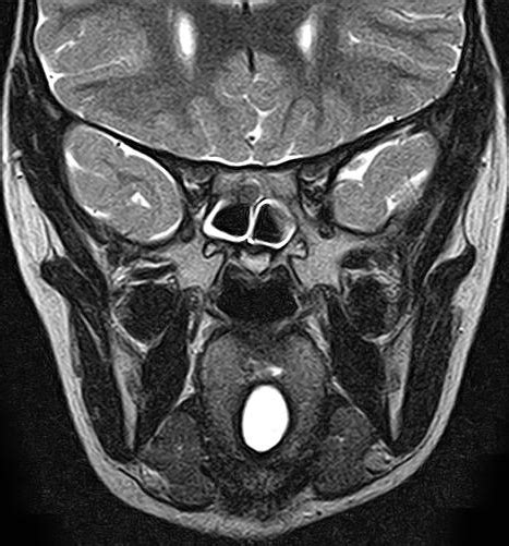 Lingual Thyroglossal Duct Cyst Image Radiopaedia Org