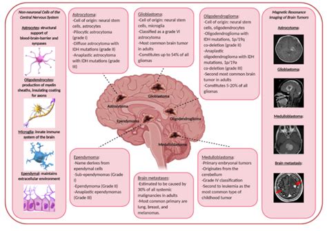 Most Common Primary Brain Tumor