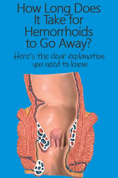 Some of the home remedies that can help get rid of petechiae fast are cold compress, baking soda, acv, olive oil, lemon juice, aloe vera etc. How Long Does It Take To Cure Hemorrhoids?: Naturally and ...