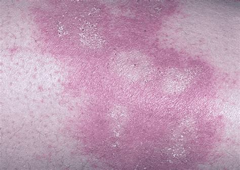 Poison Ivy Rash Pictures Symptoms Causes Treatment Youmemindbody