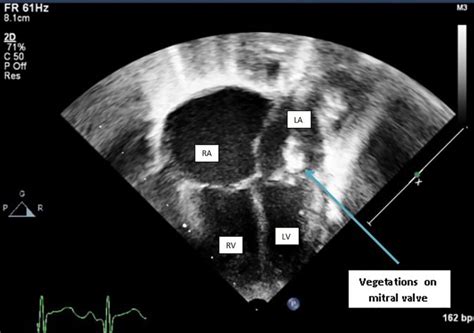 Mitral Valve Replacement In Neonatal Endocarditis Time To Discuss