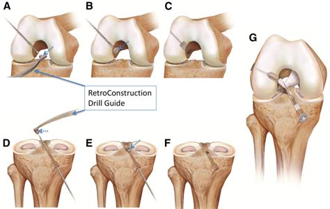 Anterior Cruciate Ligament Reconstruction With Bonepatellar Tendon