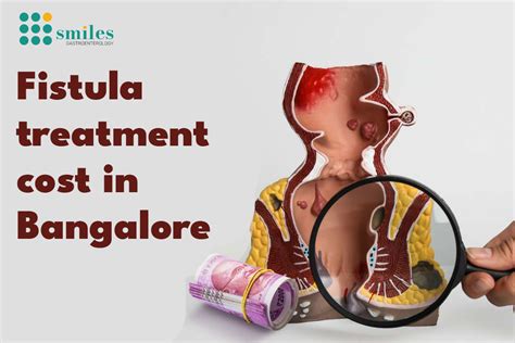 What Is The Cost Of Fistula Surgery In Bangalore Smiles Gastroenterology