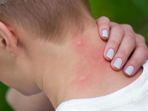 9 Bug Bite Pictures How To Identify Common Types Of Bug Bites
