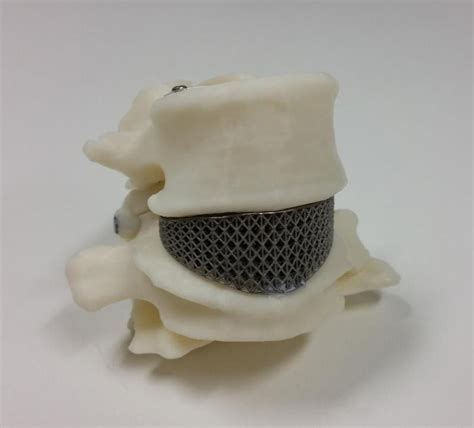 Joint Effort Produces Australias First 3d Printed Spine Implant Rmit