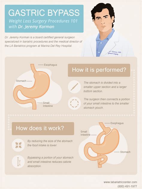 Gastric Bypass Surgery Procedure Visual Ly