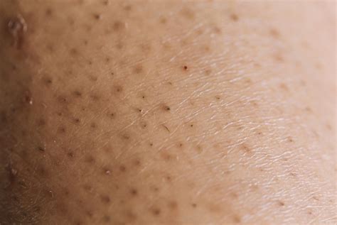How To Treat And Prevent Ingrown Hairs The Pretty Pimple