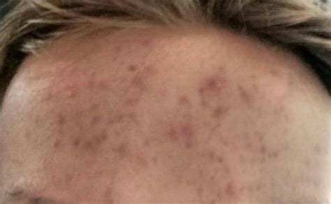 Severe Acne On Forehead Help General Acne Discussion Forum