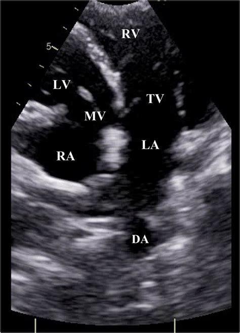 Echocardiogram Apical Four Chamber View Showing Right Atrium Ra