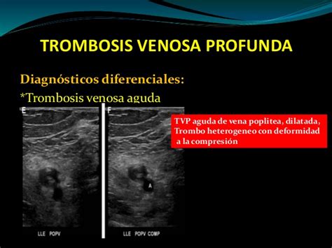 La trombosis venosa profunda puede tratarse con éxito cuando se diagnostica a tiempo. Clase de trombosis venosa profunda 2015