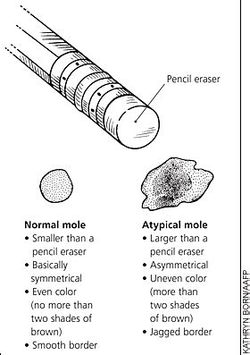 But do you know what to look for? Atypical Moles: What You Should Know - American Family ...