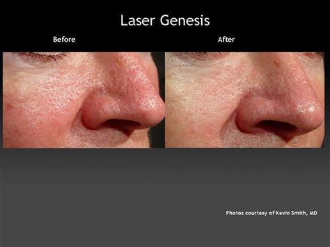 After Laser Genesis Pore Size Is Reduced As Is Redness And Visible