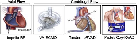 Acute Mechanical Circulatory Support Devices For The Right Ventricle