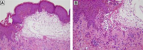 Immunologic Overlap In A Case Of Linear Iggiga Bullous Dermatosis