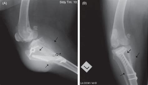 Figure 1 From Osteosarcoma At The Site Of Titanium Orthopaedic Implants