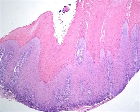 Oral Epithelial Dysplasia Atypical Verrucous Lesions And Oral