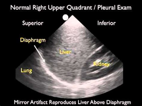 Maybe you would like to learn more about one of these? Ultrasound Detection of Pleural Fluid - SonoSite, Inc ...