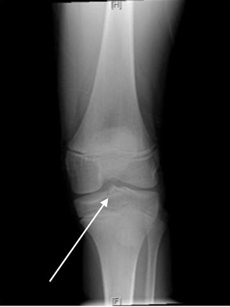 Traumatic knee pain in a child | The BMJ