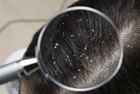 Causes Of An Itchy Scalp Is It Head Lice Lice Clinics Usa Is It