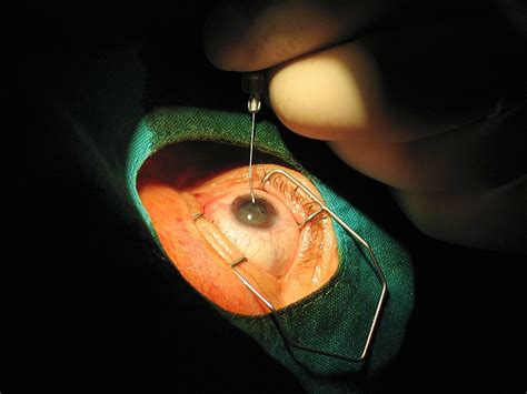 Intravitreal Injection