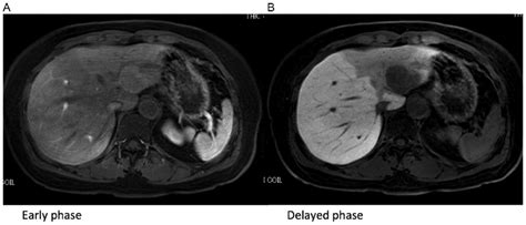 Gd Eob Dtpa Enhanced Mri Of The Liver Tumor A Gd Eob Dtpa Enhanced