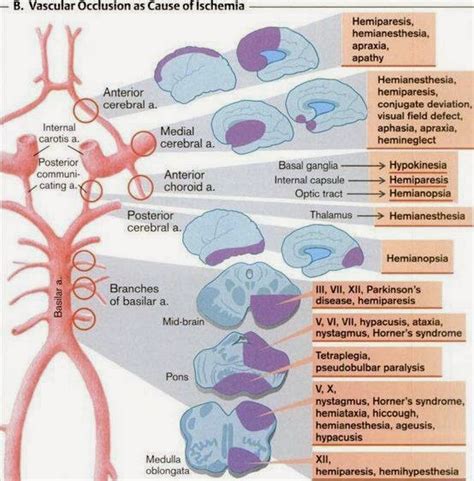 Vascular Occlusion As Cause Of Ischemia Medicosapiens