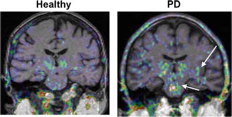 Imaging Approaches To Parkinson Disease Journal Of Nuclear Medicine