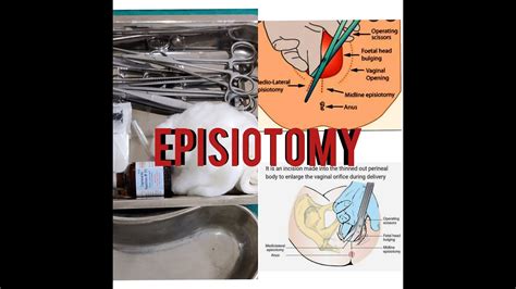 Episiotomy Episiotomy Trayinstrumenteasy Explanationsuses Youtube