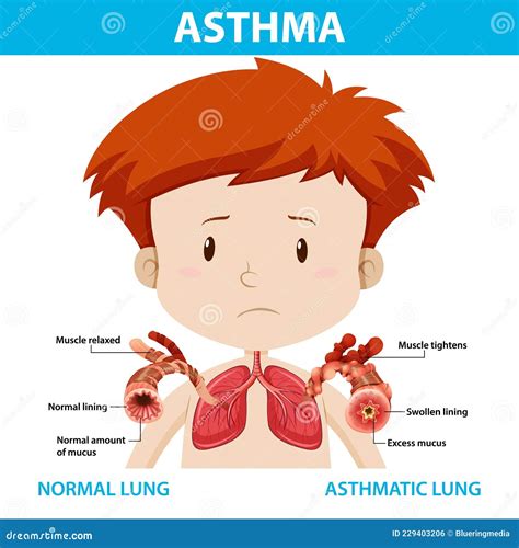 Asthma Diagram With Normal Lung And Asthmatic Lung Stock Illustration