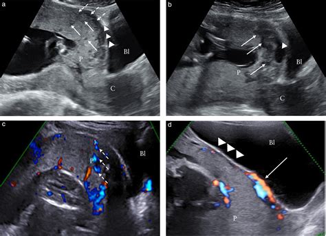 Diagnostic Accuracy Of First‐trimester Ultrasound In Detecting