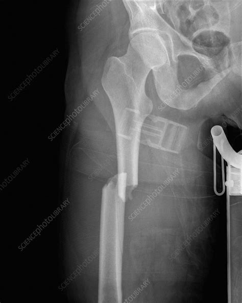 Compound Fracture X Ray
