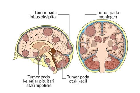 Kanker Otak Gejala Penyebab Dan Mengobati Alodokter